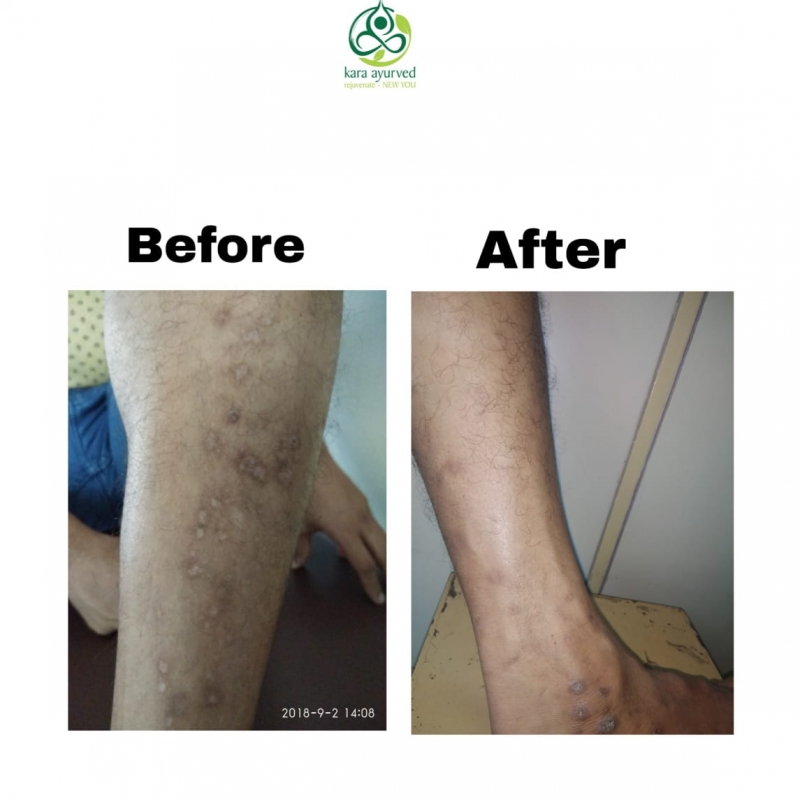 Skin Treatment Result